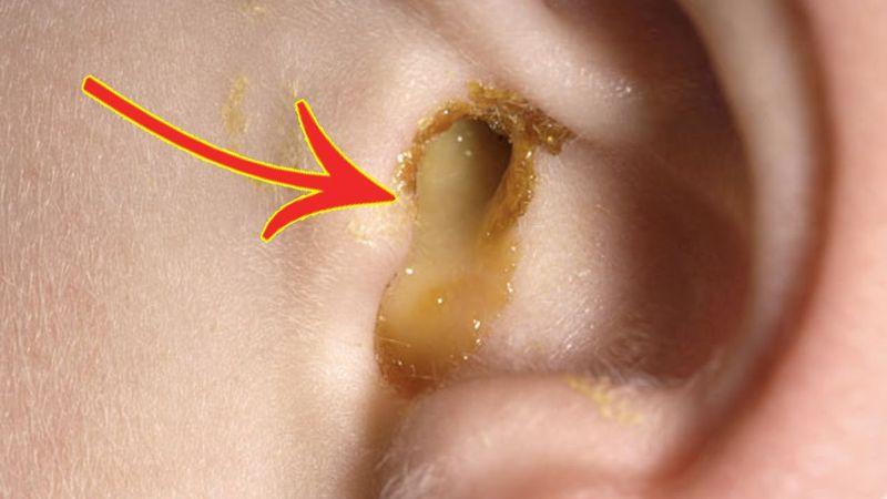 Течёт из уха: чем лечить, причины выделения жидкости