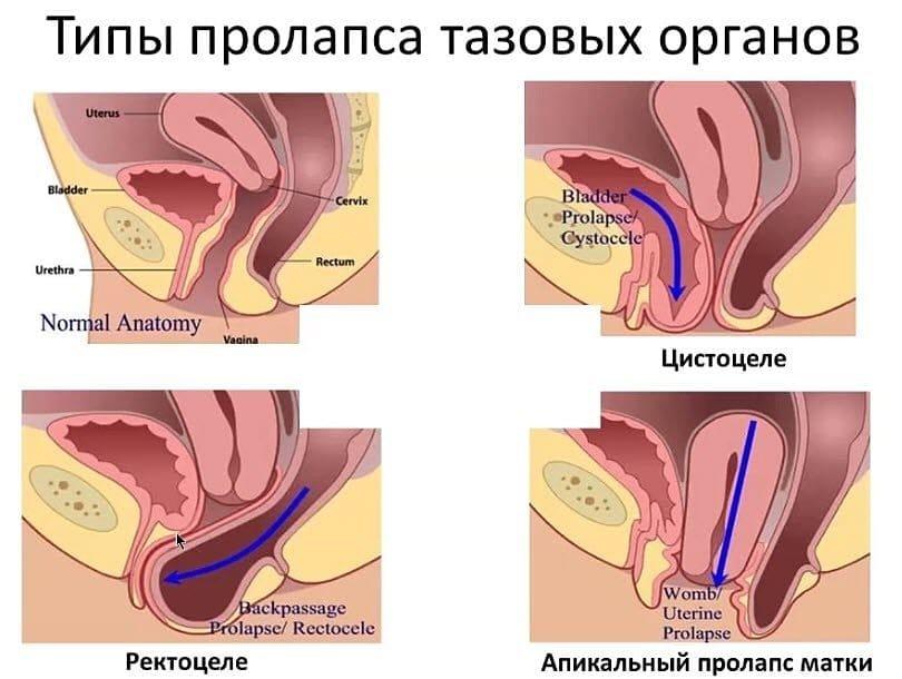 Виды пролапса влагалища