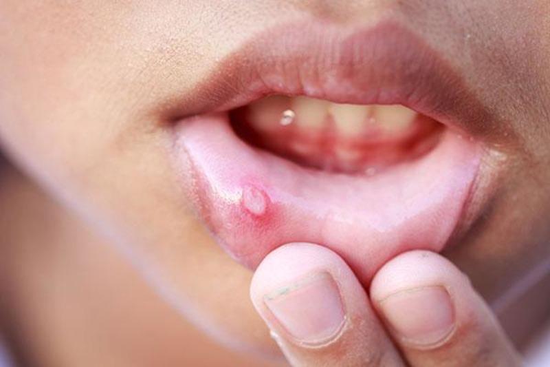 Сифилитический шанкр фото у мужчин и женщин