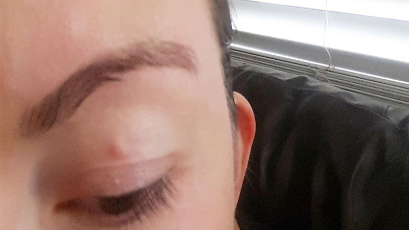 Халязион верхнего века: лечение и причины возникновения