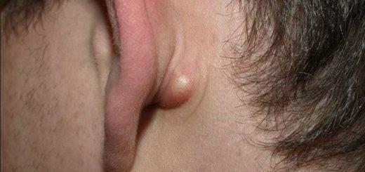 Воспалённый лимфоузел за ухом