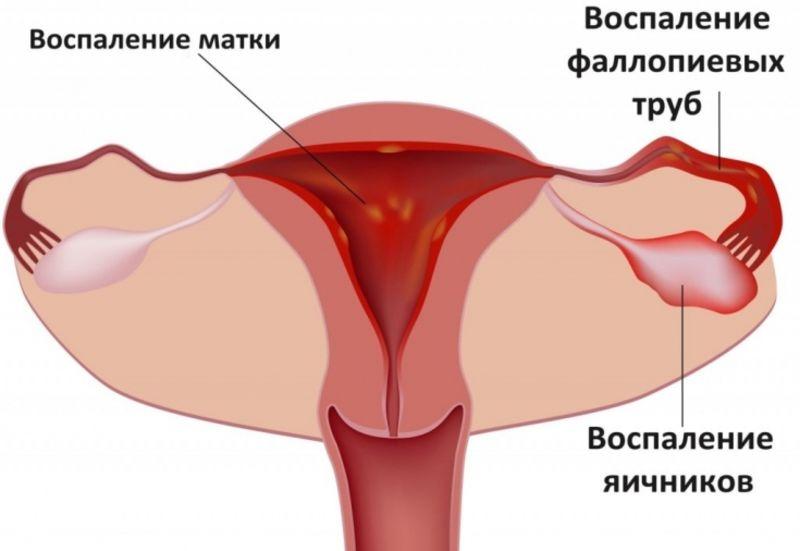 воспаление органов репродуктивной системы