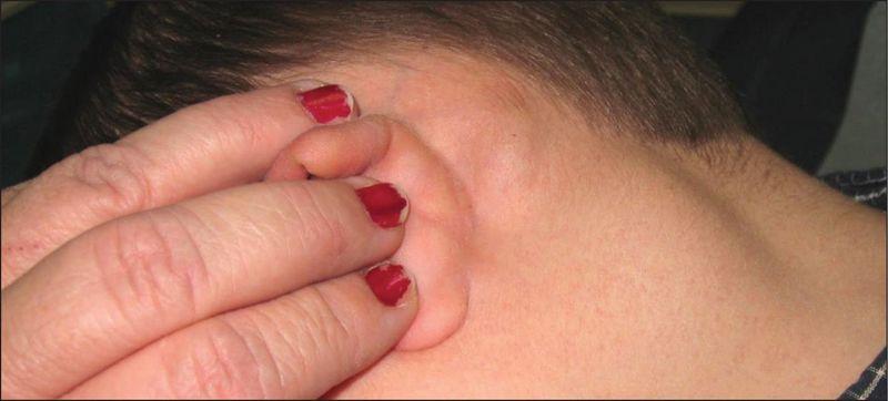 Воспаление лимфоузла за ухом
