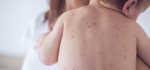 Высыпания на коже у детей – 35 распространённых заболеваний