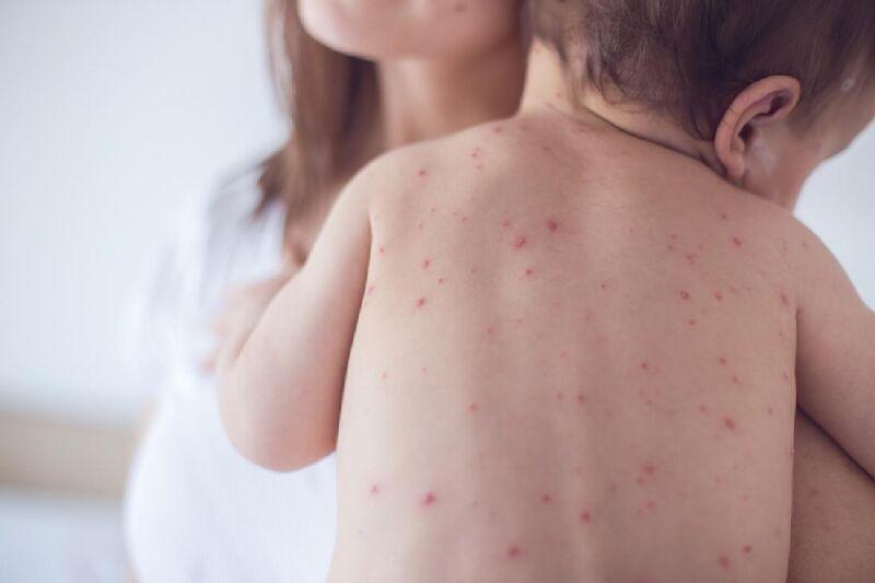 Детские кожные заболевания сыпь фото thumbnail