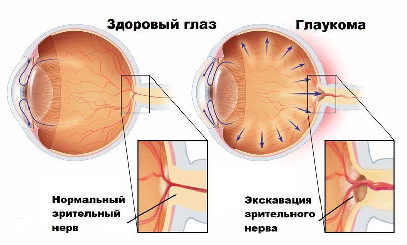 Здоровый глаз и глаукома