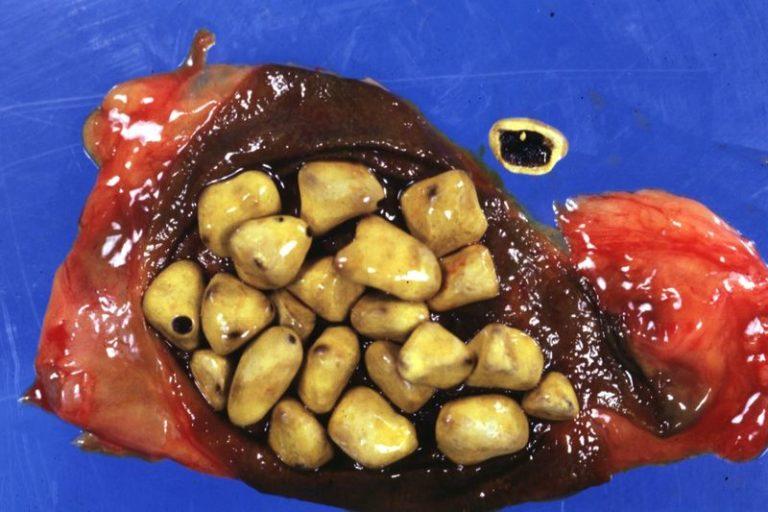 Удаление камней из желчного пузыря: цена операции и методы